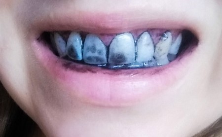 charbon dents